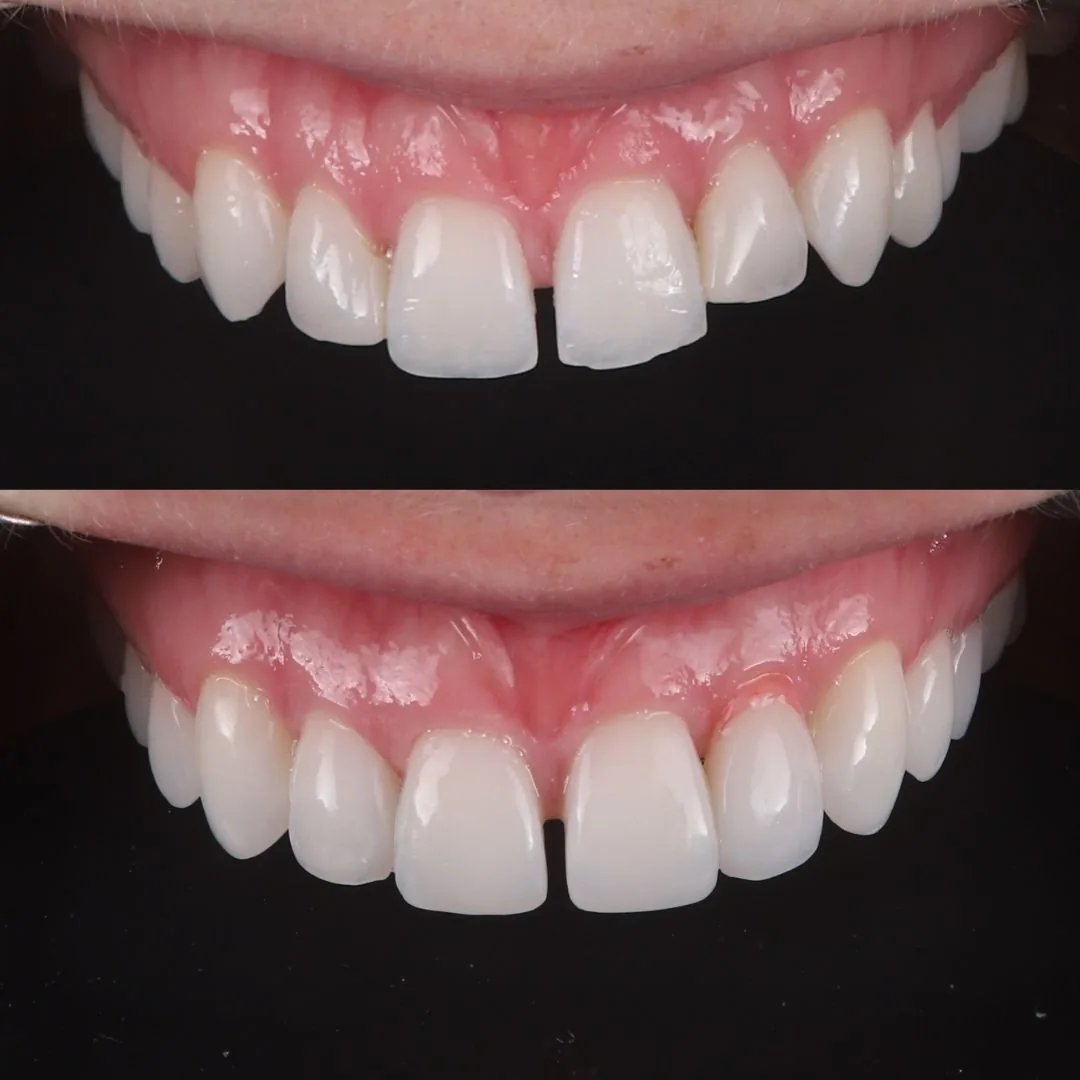 Before and after smile transformation at London Dental Arts, Forest Hill — case 25