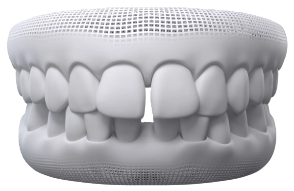 Widely Spaced Teeth alignment concern