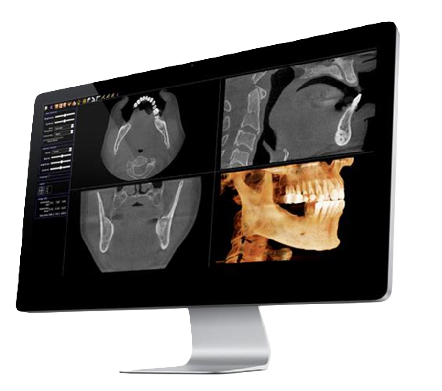 CBCT scan images on a monitor used for implant planning