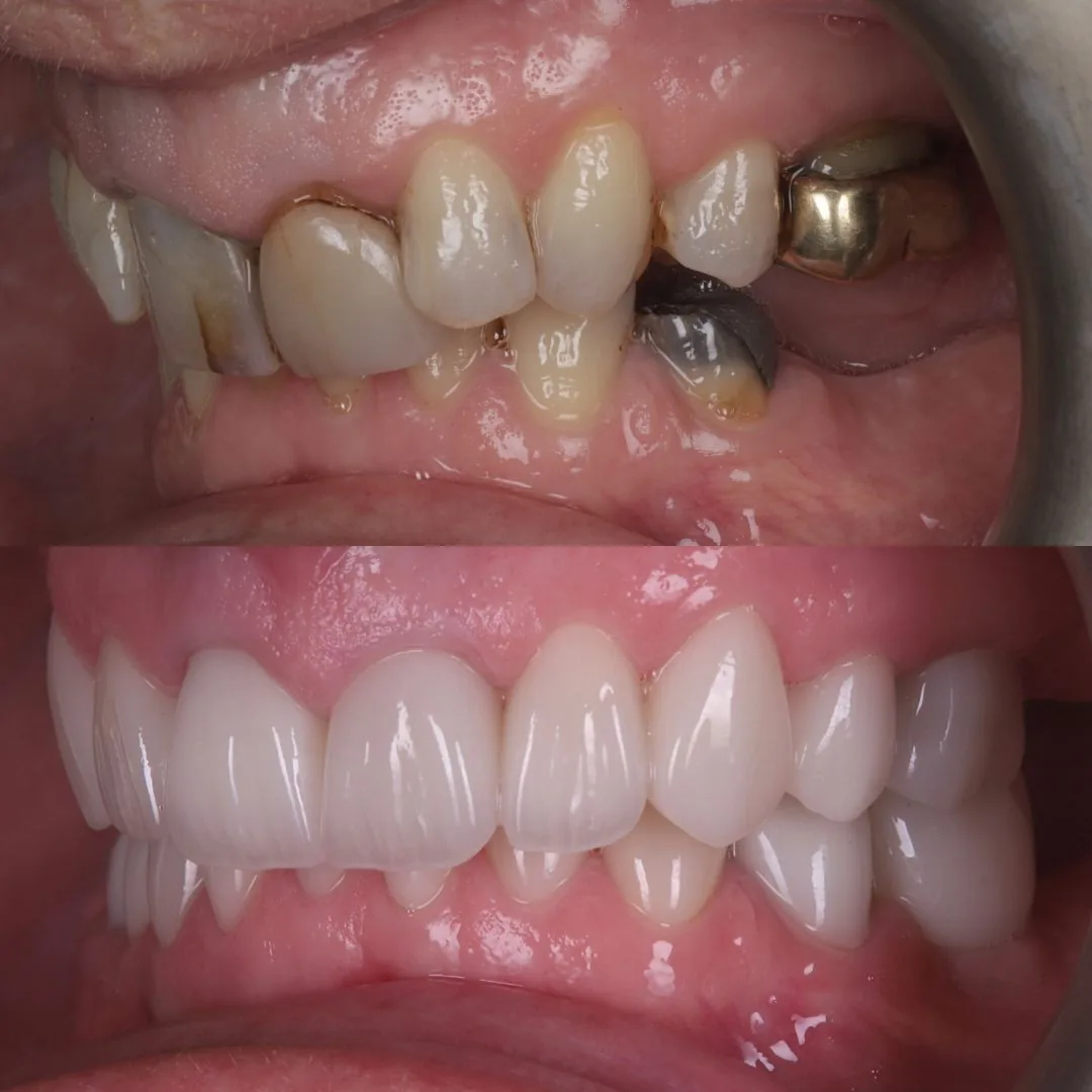 Before and after smile transformation at London Dental Arts, Forest Hill — case 41