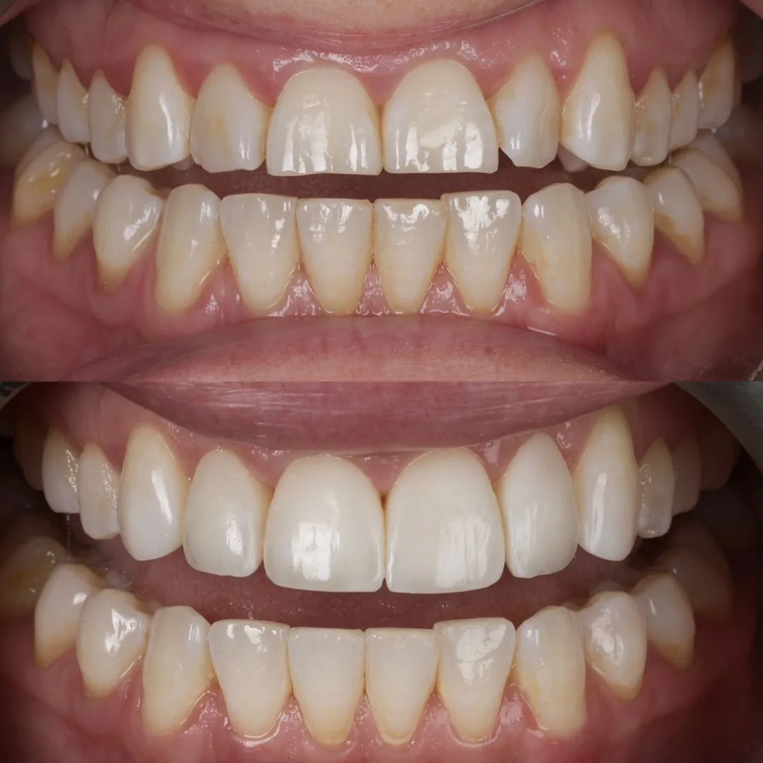 Before and after smile transformation at London Dental Arts, Forest Hill — case 11