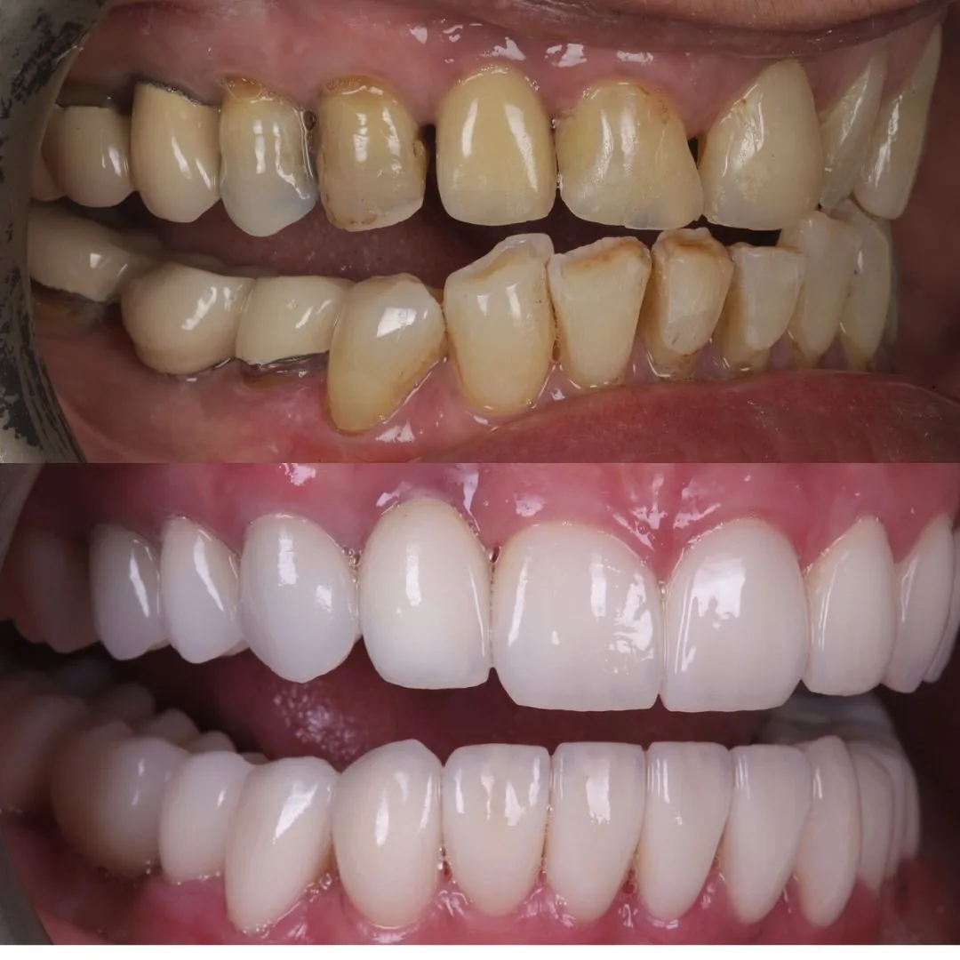 Before and after smile transformation at London Dental Arts, Forest Hill — case 35