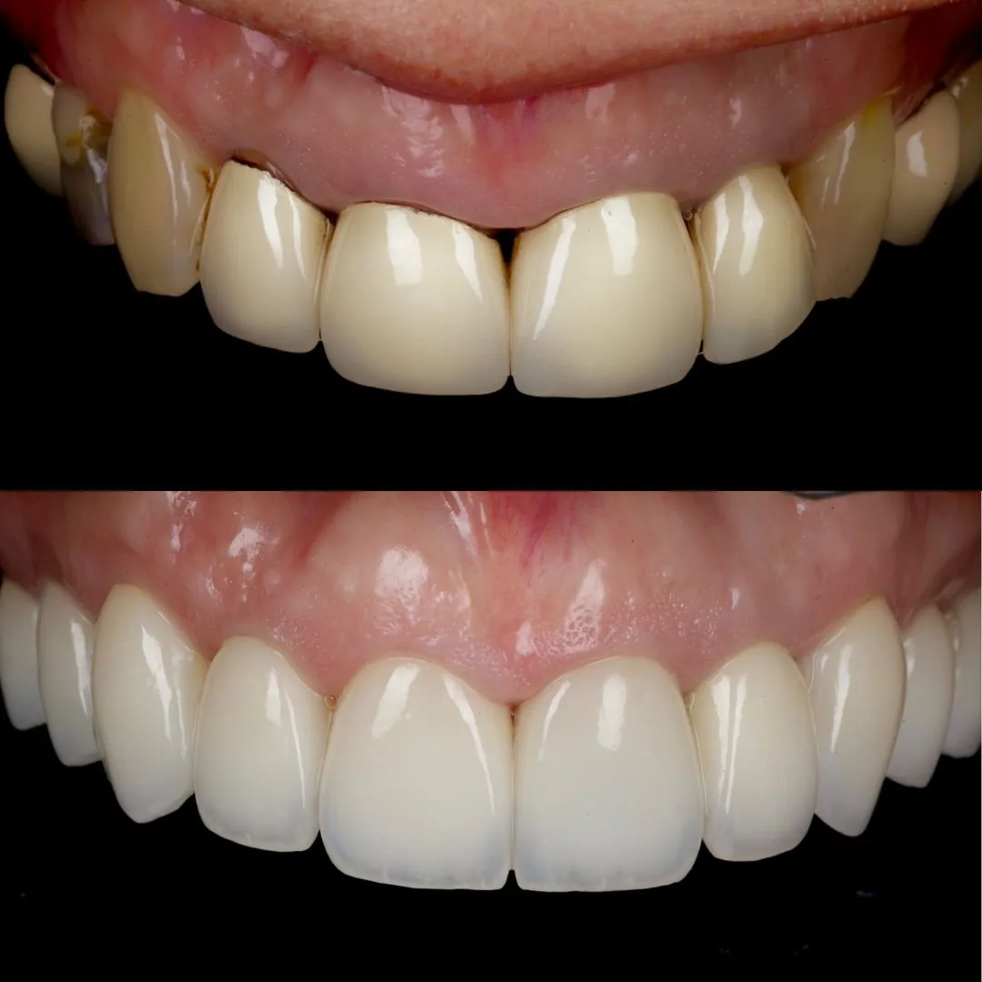 Before and after smile transformation at London Dental Arts, Forest Hill — case 19