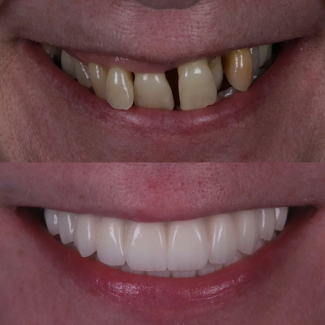 Before and after smile transformation at London Dental Arts, Forest Hill — case 40
