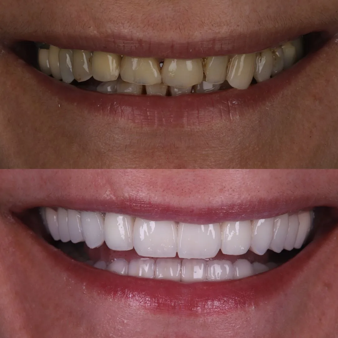 Before and after smile transformation at London Dental Arts, Forest Hill — case 30