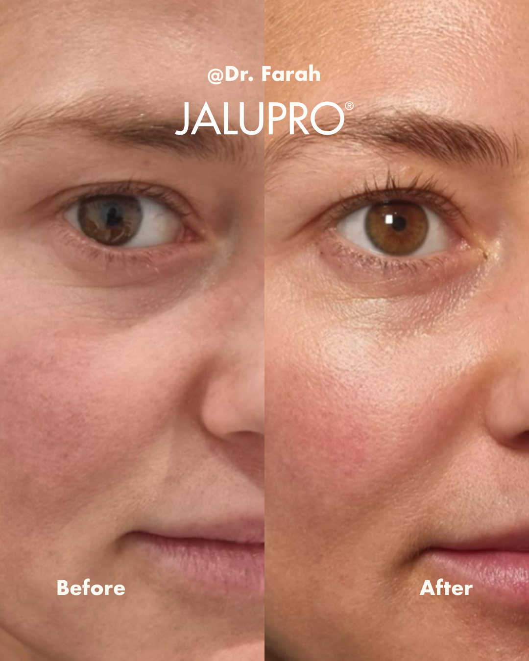 Jalupro under-eye before and after result
