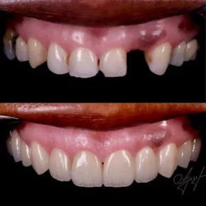 Before and after dental crown and bridge treatment restoring front teeth