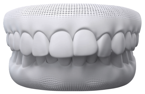 Overbite alignment concern