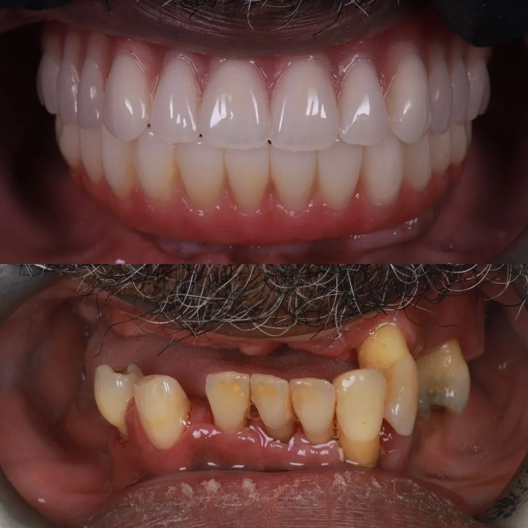 Before and after smile transformation at London Dental Arts, Forest Hill — case 34