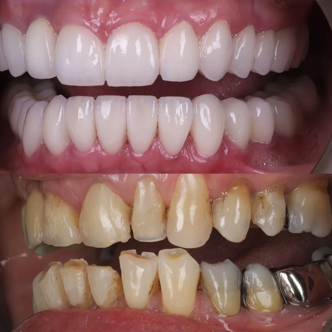 Before and after smile transformation at London Dental Arts, Forest Hill — case 26
