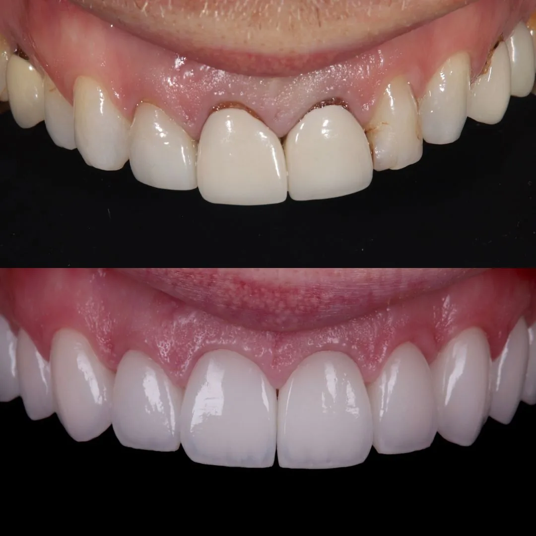 Before and after smile transformation at London Dental Arts, Forest Hill — case 46